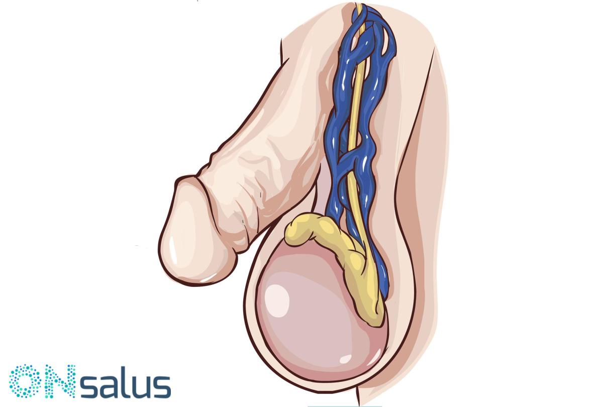Remédios caseiros para hidrocele testicular