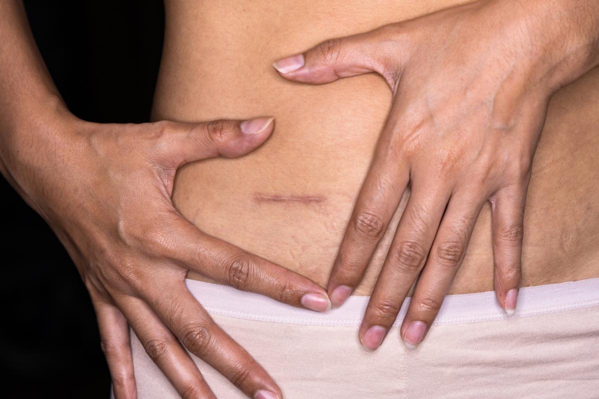 O que comer no pós-operatório de apendicite?
