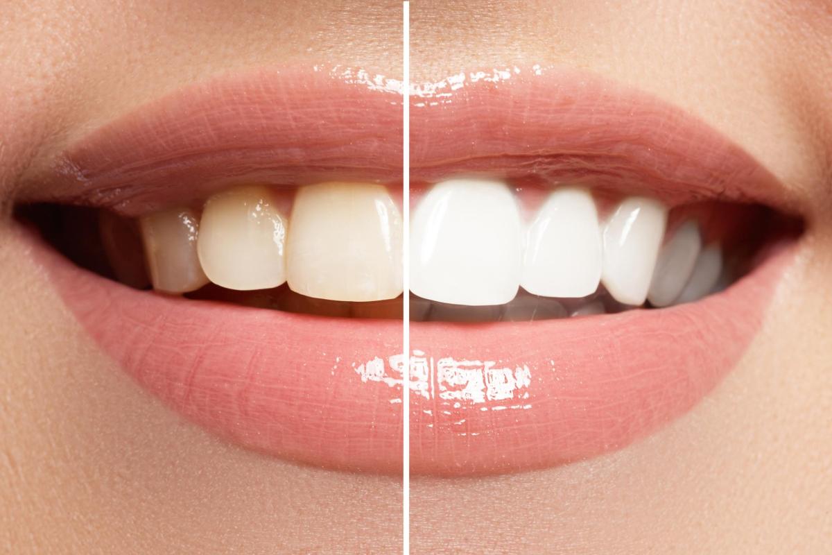 Quais tipos de clareamento dental existem?