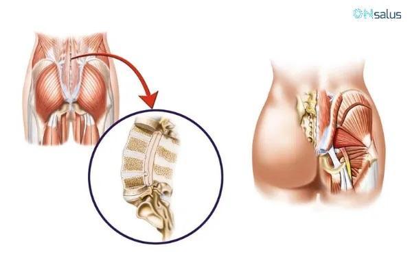 Formigamento na sola do pé - Causas e tratamento - Inflamação do nervo ciático