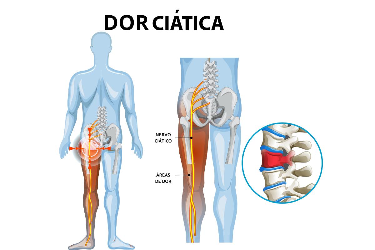 Tenho dor ciática e não consigo andar: o que fazer?