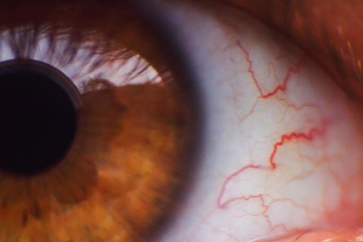 Veias vermelhas nos olhos: causas e como eliminá-las