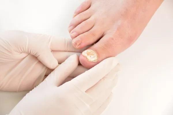 Unhas quebradiças: causas e tratamento - Infecções
