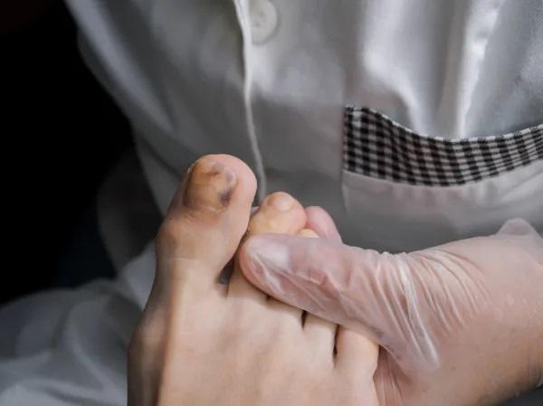 Unhas quebradiças: causas e tratamento