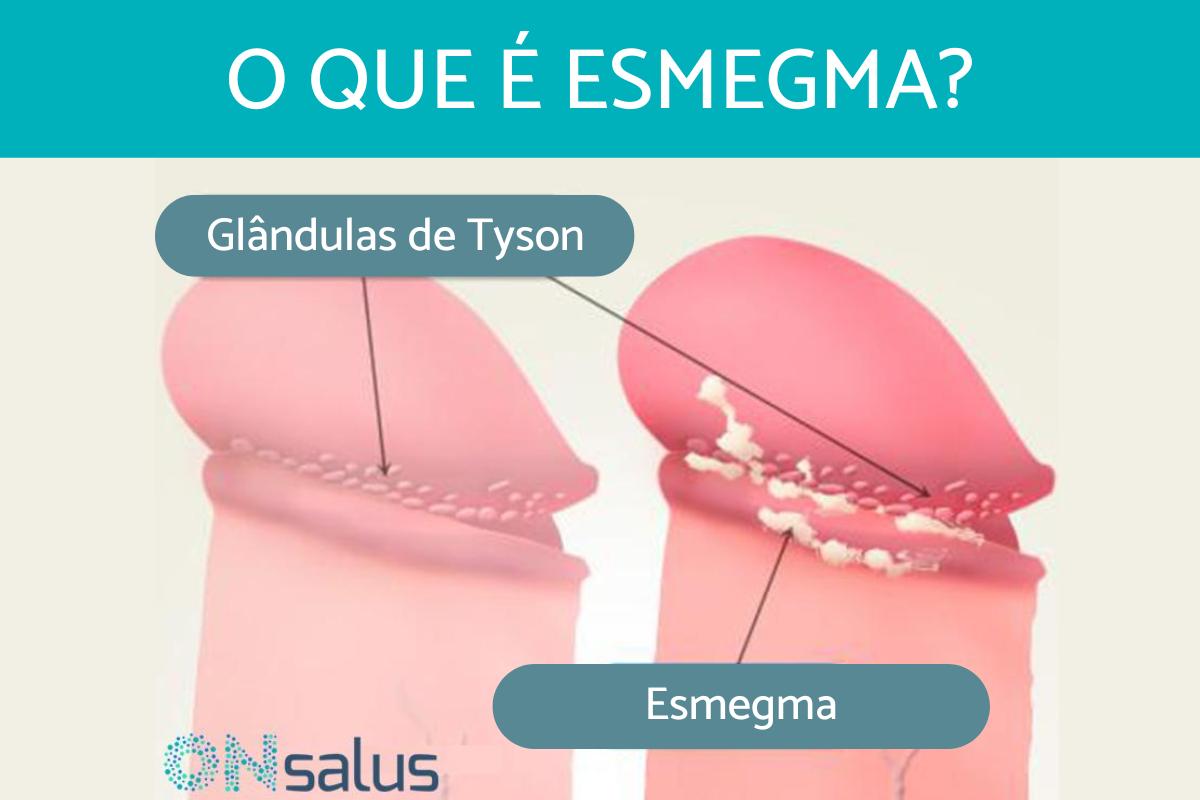 O que é o esmegma e como eliminá-lo