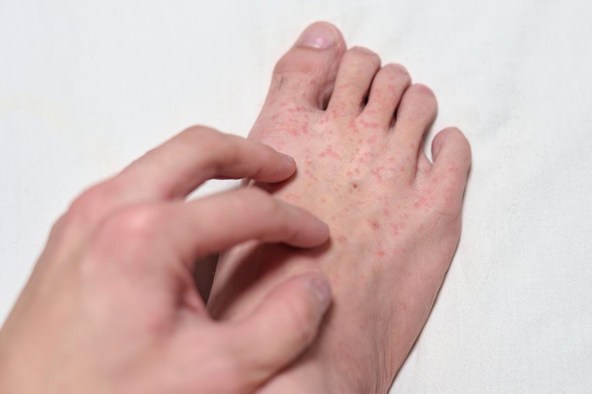 Espinhas nos pés que coçam muito: causas e tratamento