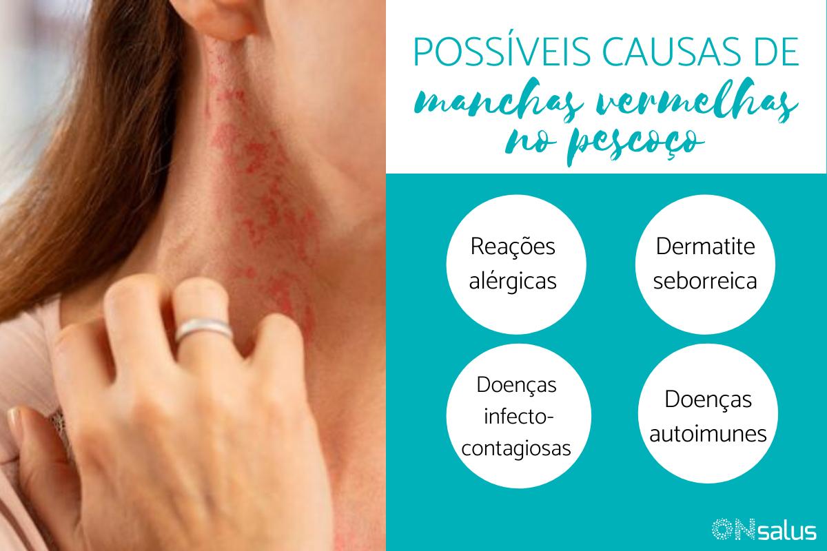 Manchas vermelhas no pescoço: o que podem ser