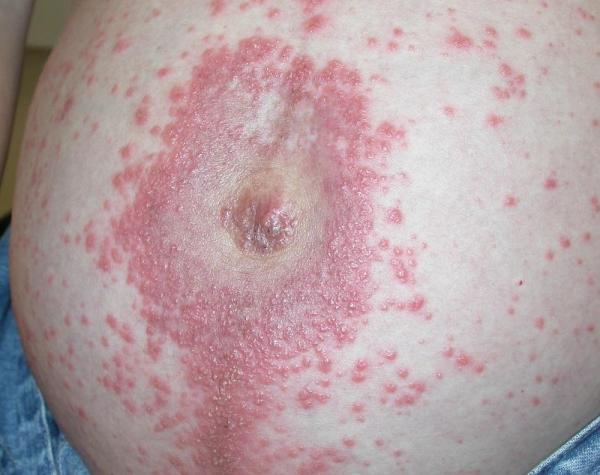 Coceira na gravidez: causas e recomendações - Herpes gestacional