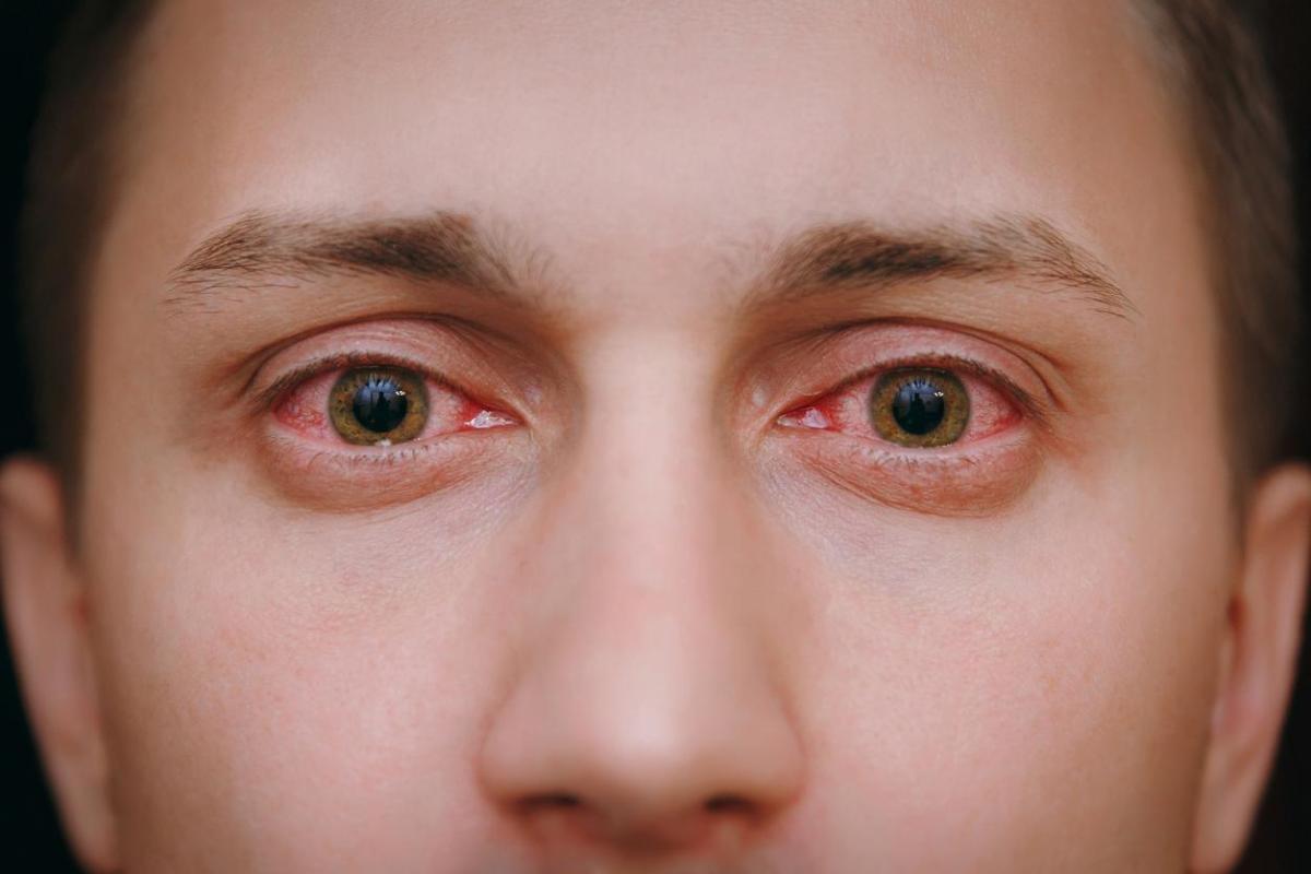 Olhos vermelhos ao acordar: causas e soluções