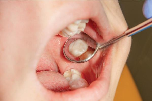 Gengiva inflamada ao redor de um dente: Causas e tratamento - Erupção e infecções dentárias