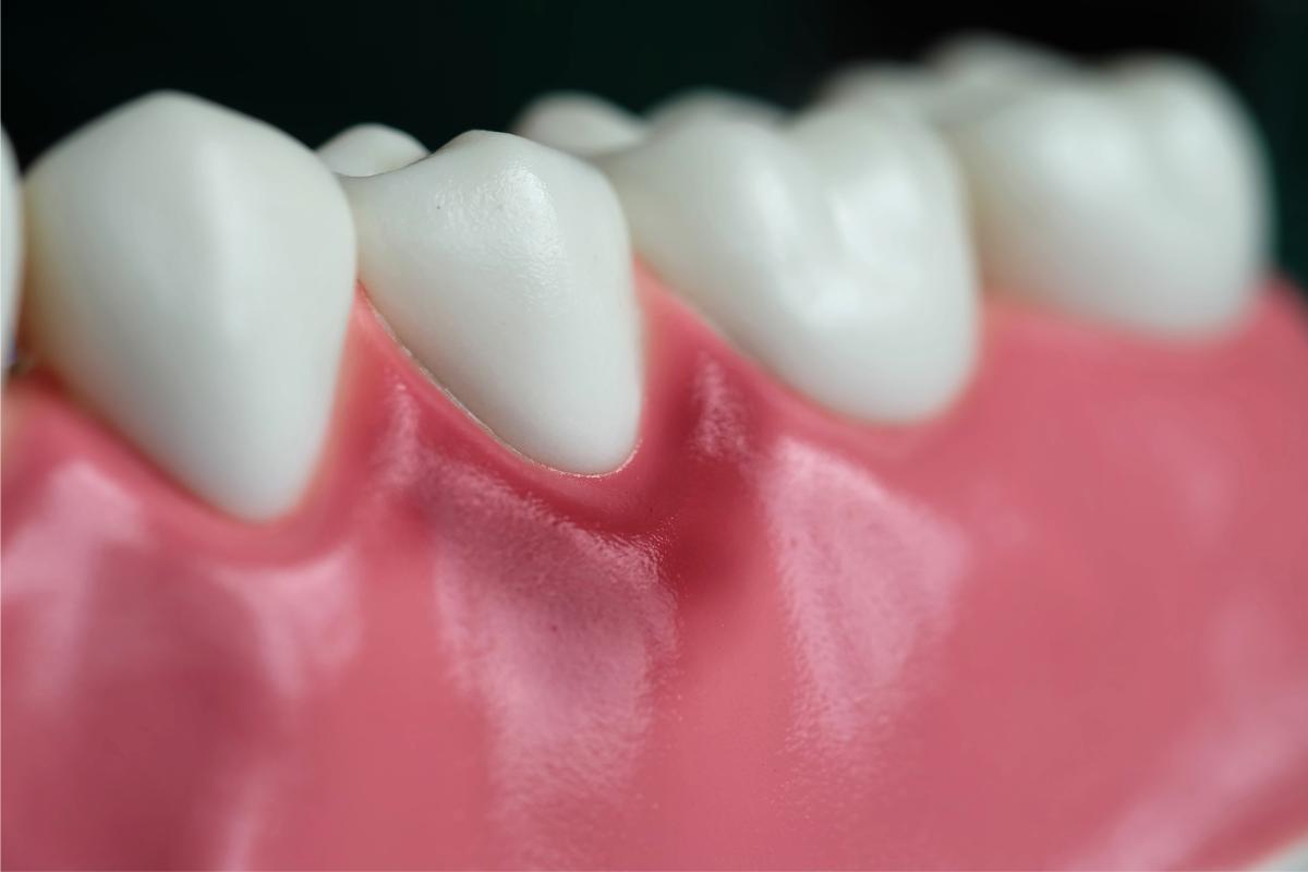 Gengiva inflamada ao redor de um dente: Causas e tratamento
