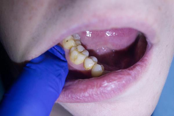 Gengiva inflamada ao redor de um dente: Causas e tratamento - Tártaro 