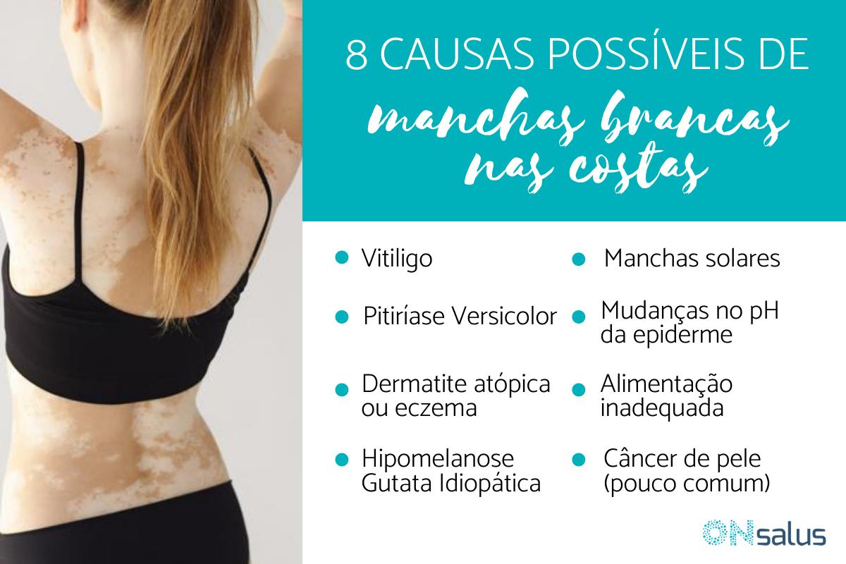 Manchas brancas nas costas, o que pode ser?
