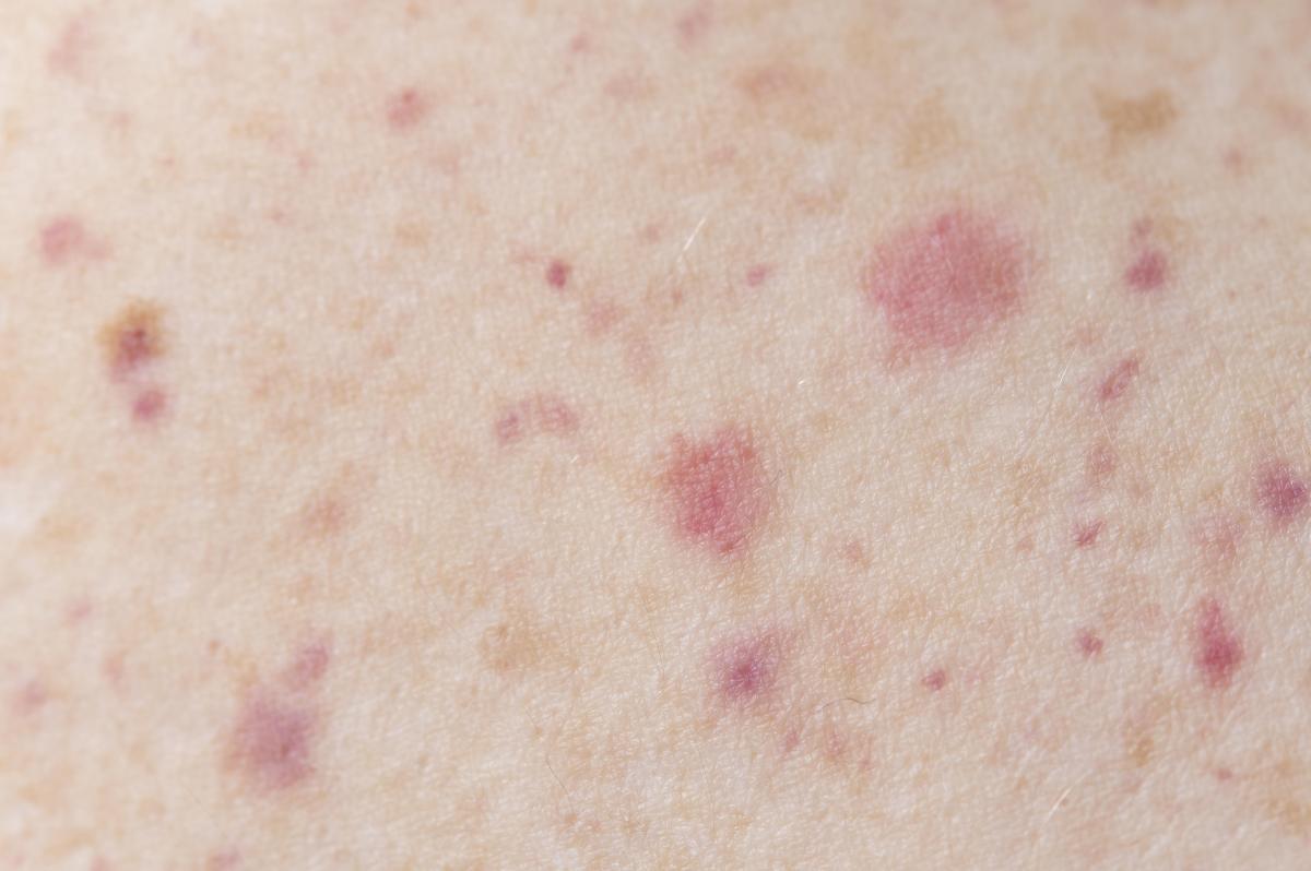 Irritação com coceira na barriga: causas e tratamento