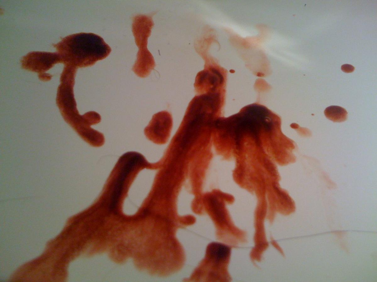 Esperma com sangue: o que pode ser