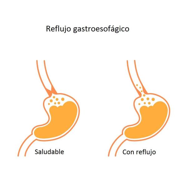 Refluxo gastroesofágico: tratamento, sintomas e causas - Porque temos refluxo?