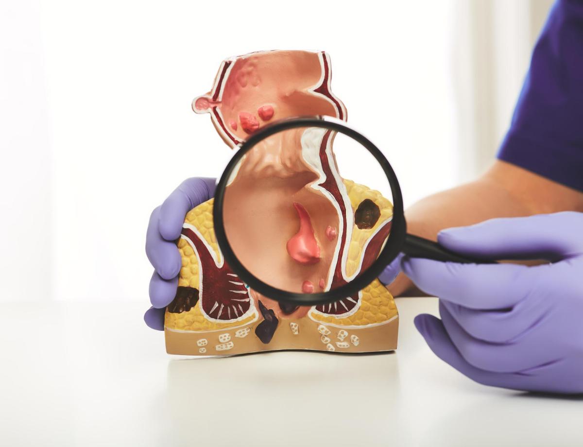 Quanto tempo demora para curar uma fissura anal?