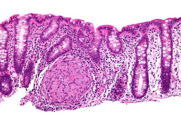 Doença de Crohn: sintomas e tratamento