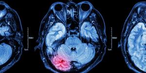 Sintomas de derrame cerebral ou AVC