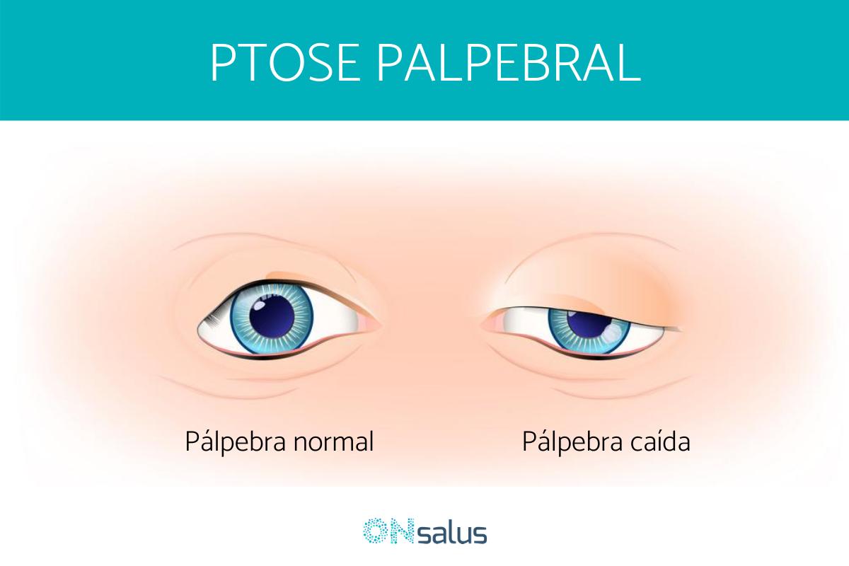 Por que tenho uma pálpebra mais caída que a outra?