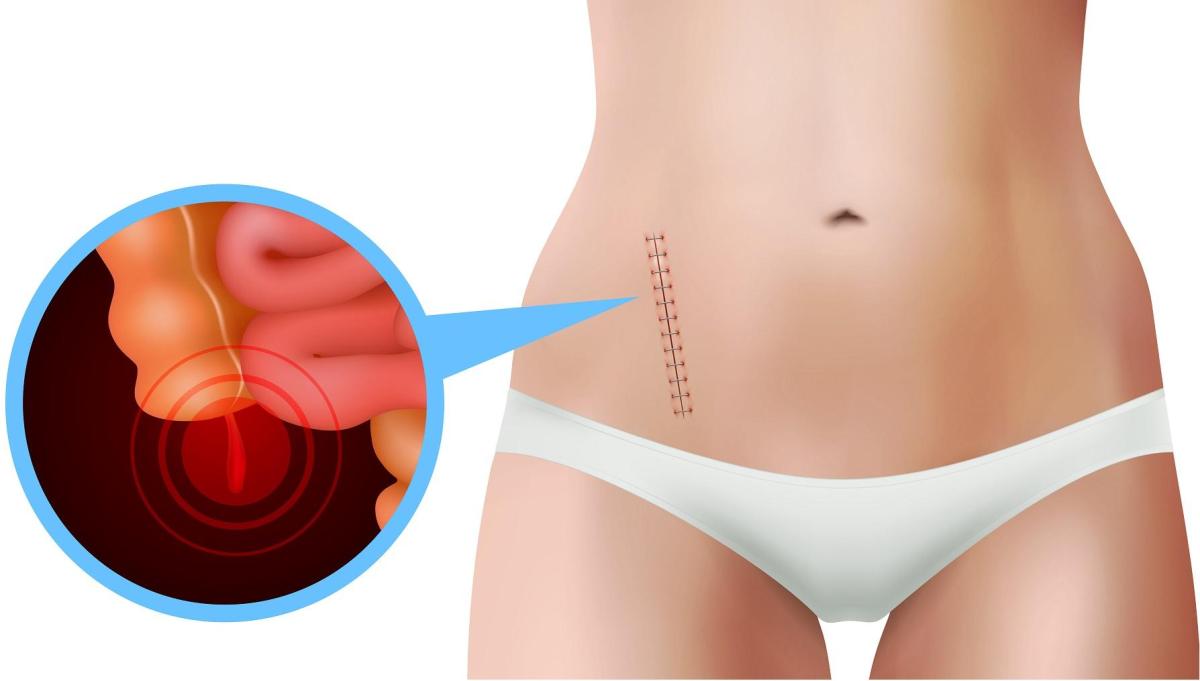 É normal sentir dores após cirurgia de apendicite?