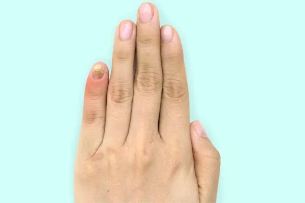 Unhas danificadas por lixa elétrica: causas e soluções - Infecções nas unhas