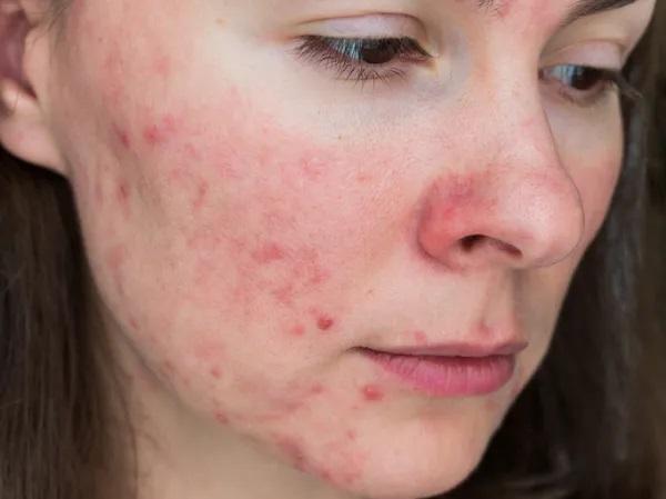 Roacutan: efeitos colaterais de curto e longo prazo - Para que é utilizado o Roacutan