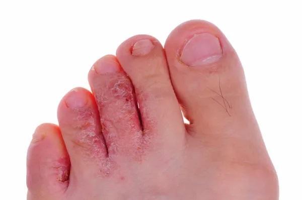 Acabe Com a Coceira e Rachaduras Nos Dedos dos Pés! + 6 Causas