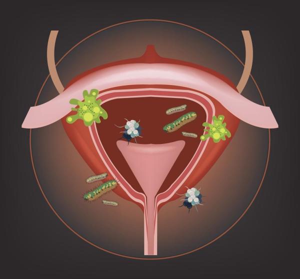 O que acontece se uma infecção do trato urinário não for curada? - Por que uma infecção do trato urinário não responde aos antibióticos