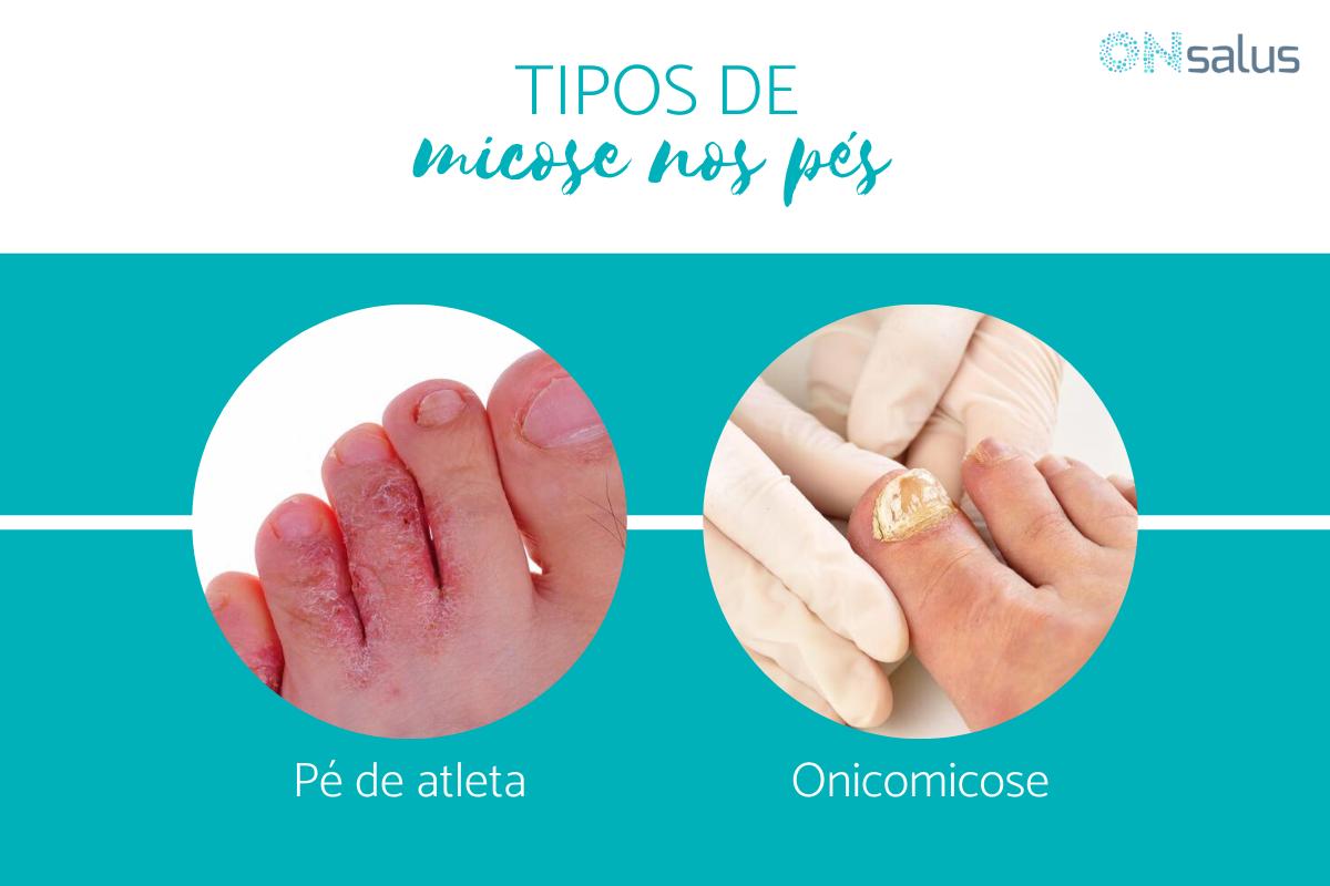 Tipos de micose nos pés - com fotos