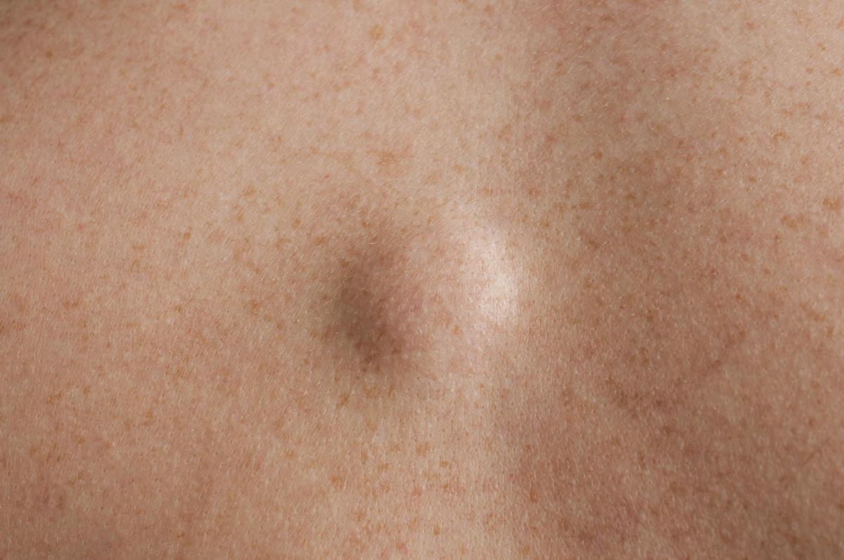 Lipoma na axila: o que é, causas e tratamento