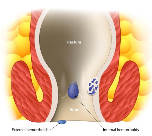 Como curar hemorróidas externas rapidamente - Hemorroida externa: sintomas