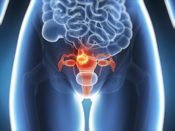 Corrimento marrom depois da menstruação: o que pode ser - Corrimento marrom após menstruação: cáncer cervical