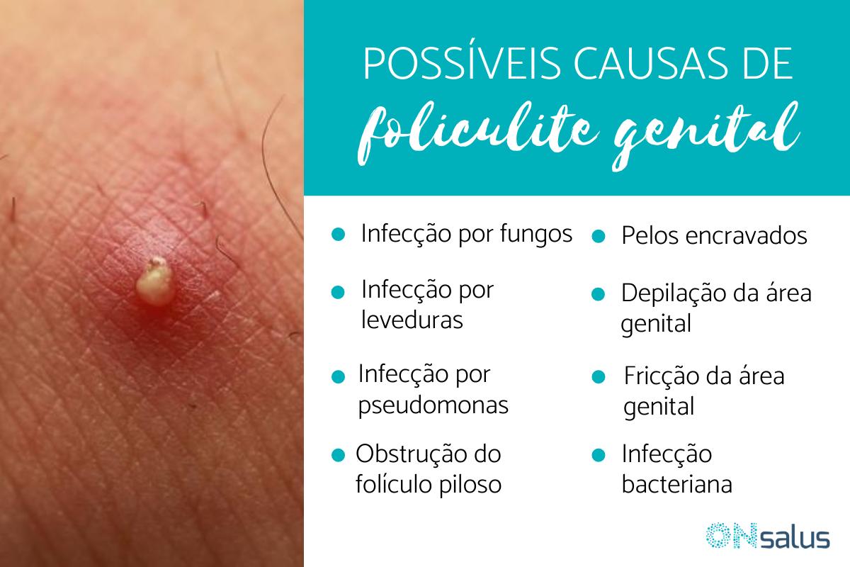 Foliculite genital: causas, sintomas e tratamento