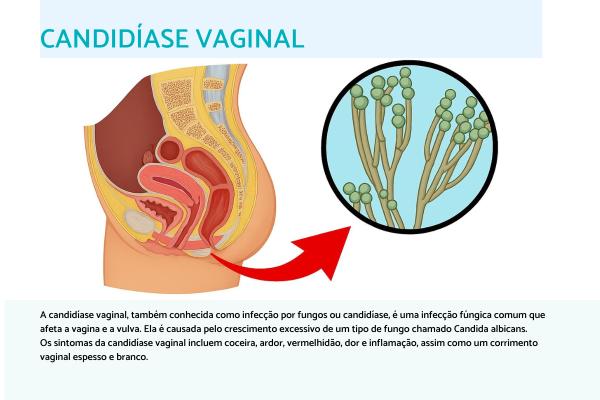 Candidíase por antibiótico: se cura sozinha ou precisa de tratamento? - Quais são os sintomas da candidíase associada ao uso de antibióticos?