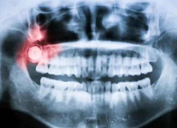 Dor na mandíbula perto do ouvido - Causas e tratamento - Nascimento dos dentes do siso