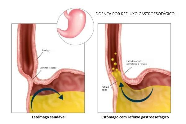 Nariz entupido sem coriza à noite: causas e tratamento - Refluxo gastroesofágico