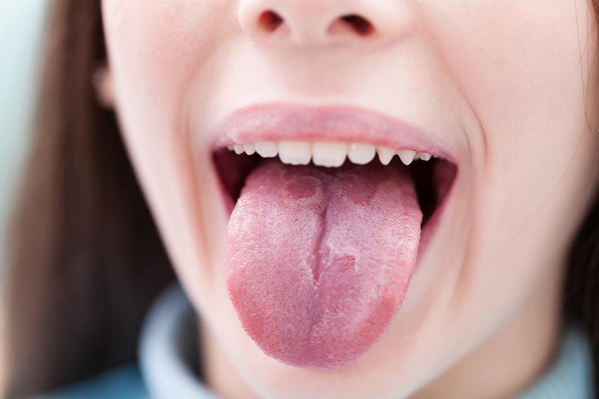 Bolinhas vermelhas na língua: 8 causas para ficar atento