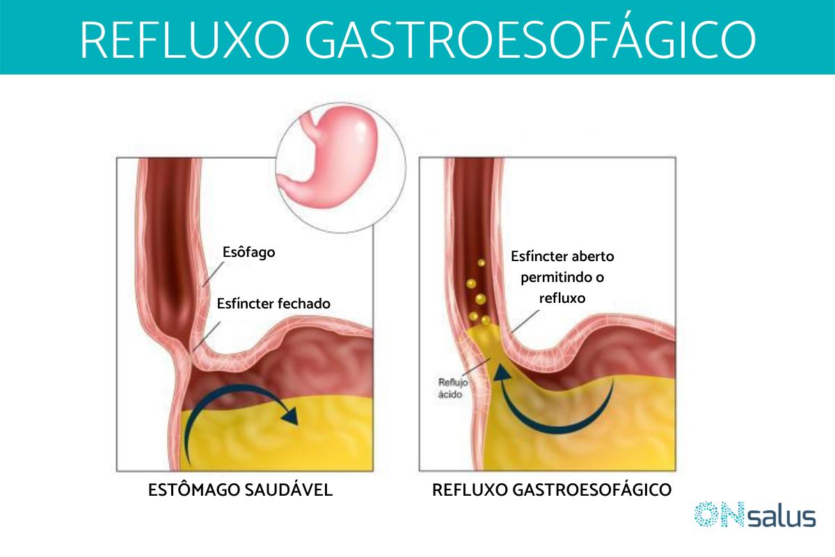 O que causa PIGARRO na GARGANTA: Tratamento e remédios caseiros