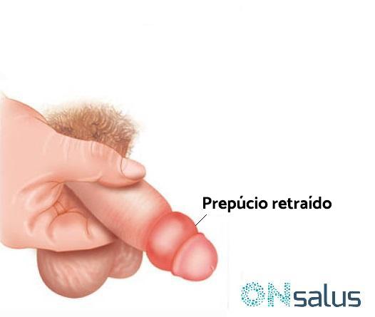 Parafimose: causas, sintomas e tratamento - Causas da parafimose em adultos