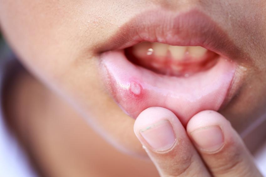 Bolha de sangue na boca: o que pode ser - Causas e tratamentos