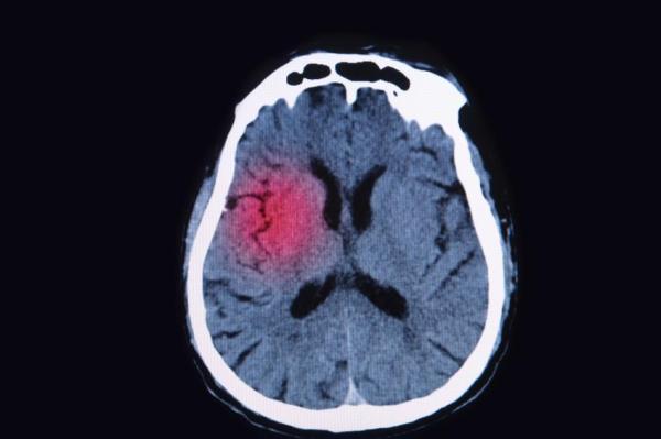 Aneurisma cerebral: sintomas, tratamento e causas