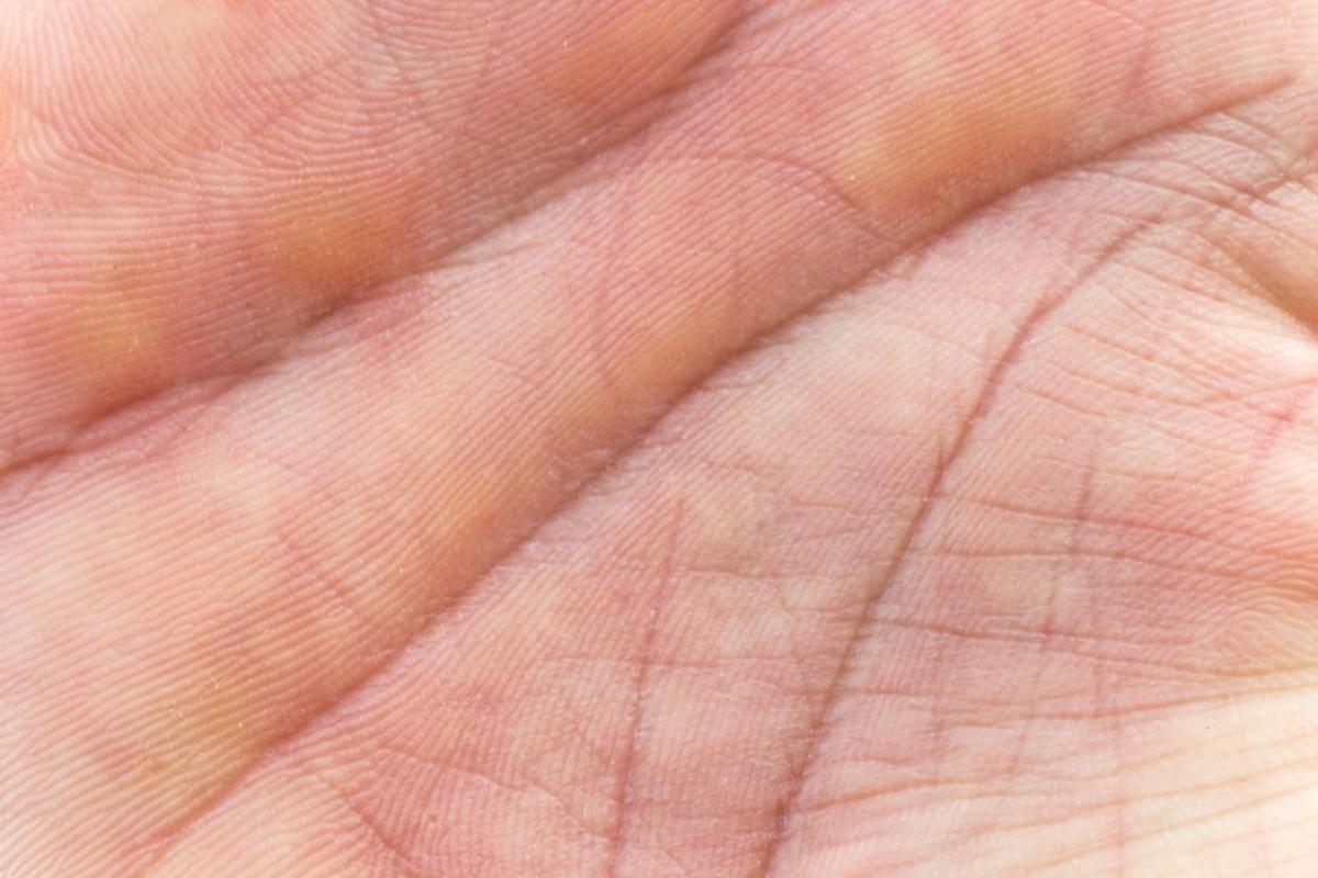 Manchas amarelas nas mãos: causas e tratamento