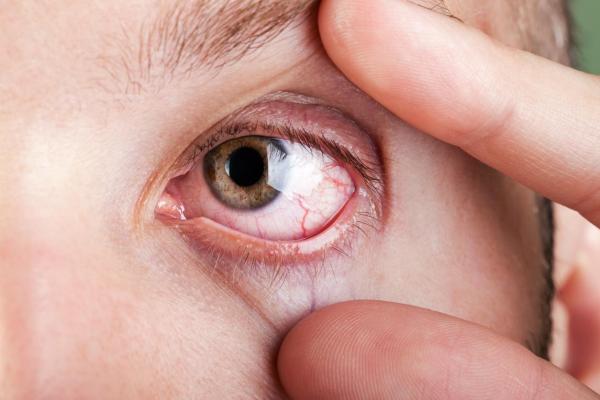 Olhos secos: causas e tratamento