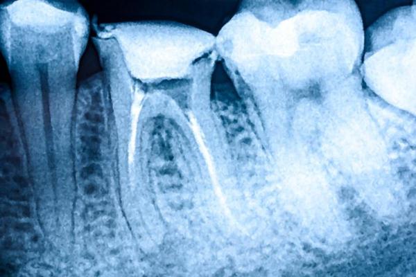 Dente do siso inflamado depois da extração: quantos dias dura - Sobre os dentes do siso