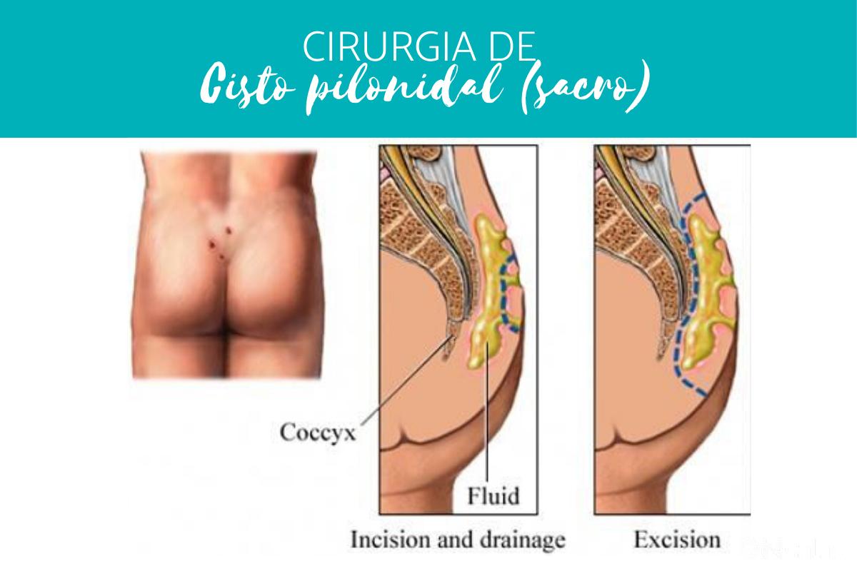 Cisto pilonidal (sacro): causas, sintomas e tratamento