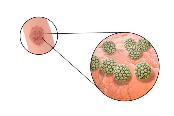 Verrugas no pênis: causas e tratamentos