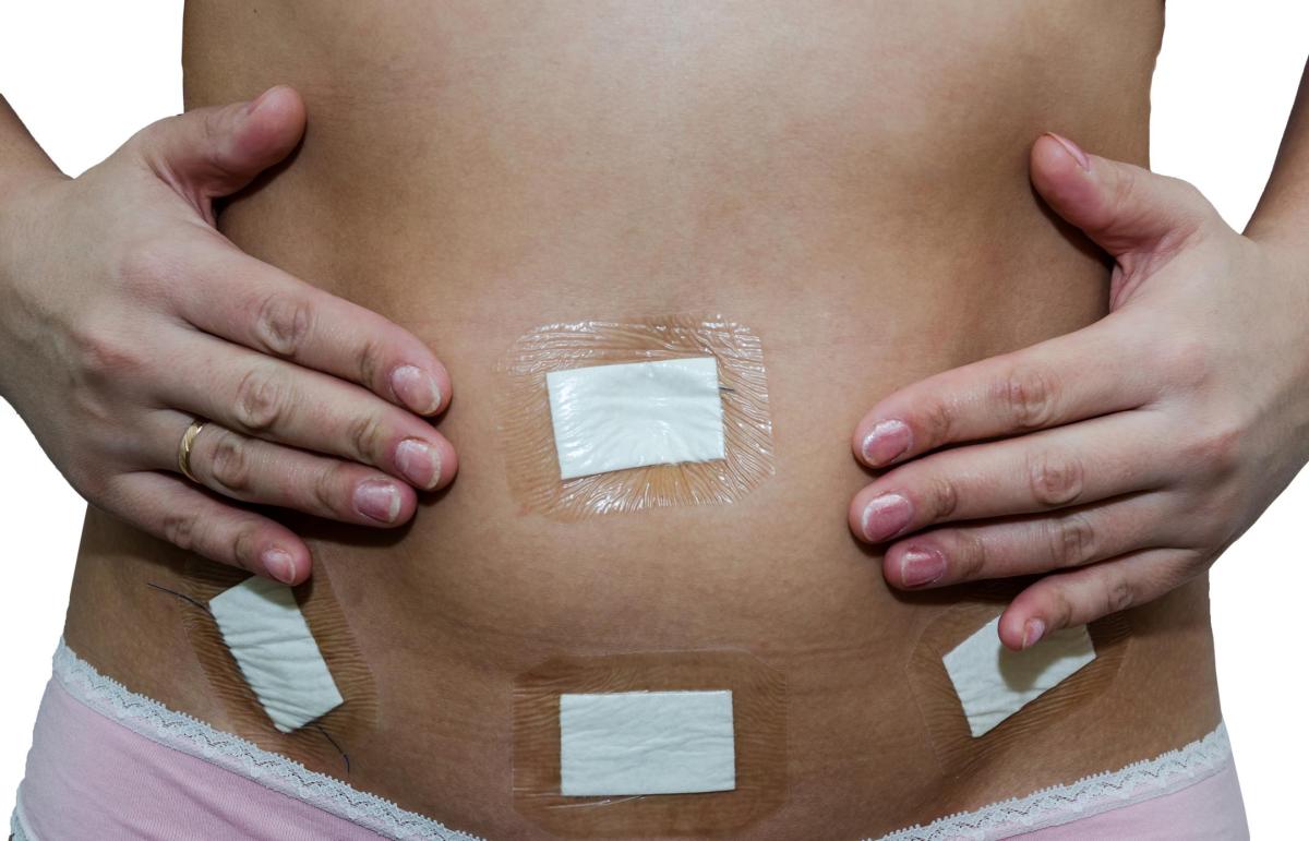 Barriga inchada após videolaparoscopia é normal?
