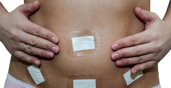 Barriga inchada após videolaparoscopia é normal?