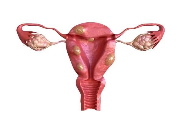 Coloquei o DIU e não paro de menstruar - Causas do sangramento prolongado com o DIU